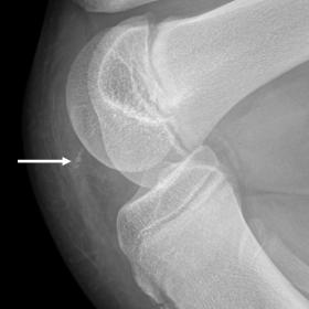 Lateral radiograph of the right knee.