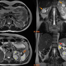 A comparison between MRI of the upper abdomen performed in 2004 and 2023 reveals significant changes. Axial (A) and coronal (