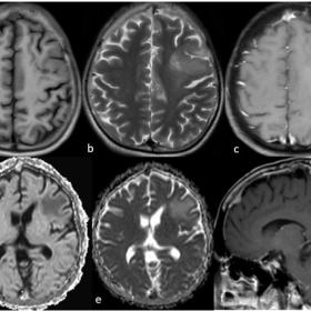 MI brain with T1W axial (a), T2 weighted axial (b), DWI (d), ADC map (e), T1 post contrast axial (c) and sagittal (f) images 