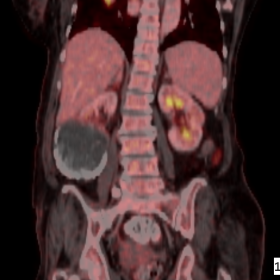 FDG PET scan (coronal) shows no metabolic activity in the lesion at the lower pole of right kidney and lesion in segment VIII