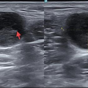 Ultrasonography demonstrated a well-circumscribed hypoechoic lesion in the back of the left knee measuring ~1.58x1.25 cm. Few