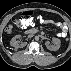 Axial non-contrast CT scan shows a well-circumscribed, hypodense nodule measuring 2.3 cm in the right perirenal space (arrow)