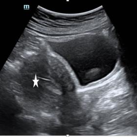 Sagittal ultrasound image of uterus reveals that there is non-visualisation of IUCD within the endometrial cavity (white star) or the myometrium.