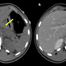 Axial CT images, before (A) and after contrast administration on a portal-venous phase (B). Well-defined mass of 40x15mm loca