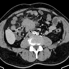 Post-contrast axial CT showing a solid, hyper-enhancing and irregularly shaped mesenteric mass, as well as peri-mesenteric fa