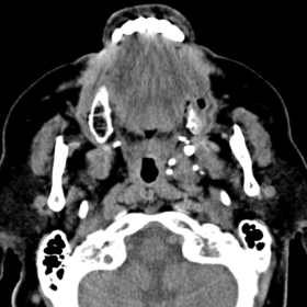 Axial non-contrast CT: Soft tissue mass occupying the left parapharyngeal space with multiple phleboliths.