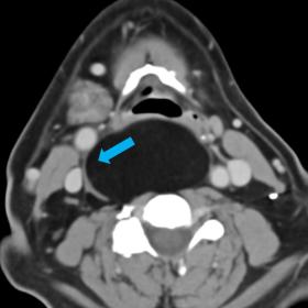 Axial CT: Well-defined fat density mass in the retropharyngeal space displacing the right carotid space laterally and posteri