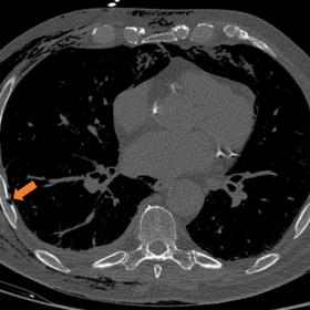 Axial CT image (bone window) showing fracture of the seventh right rib (arrow).