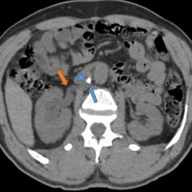 CT urogram, axial view, reveals a stone (indicated by the blue arrow) located behind the inferior vena cava (marked with a star), causing a blockage in a retrocaval ureter with a kinking sign (highlighted by the orange arrow). These factors collectively contribute to ureterohydronephrosis upstream. a) Without injection of contrast product. b) Portal phase. c) Delayed phase MIP reconstruction.