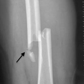 X-ray of the left (1a) and right (1b) thigh show comminuted displaced closed fractures (black solid arrows) of the mid diaphysis of the femur.