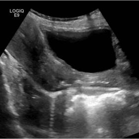 Sagittal sonographic view depicting free extraluminal air posterior to the uterine cervix, in extraperitoneal site as multiple reverberation artefacts accompanied by the characteristic sonographic “dirty shadow”.