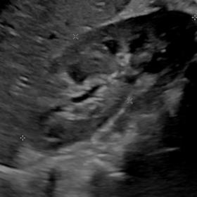 Ultrasound image of the right flank region shows the orthotopic normal appearing right kidney.
