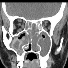 CT showing bilateral sinonasal polyps with hyperdense areas within.