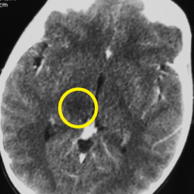 Hypodense lesion in the right thalamus (Figure 1a) and bilateral cerebellar lesions (Figure 1b) not enhancing with contrast.