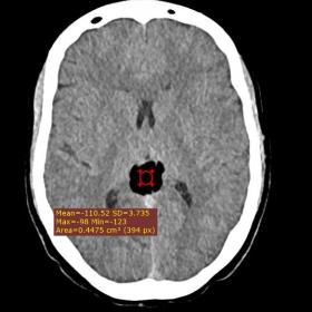 Axial non-contrast CT scan of the brain showing a well-defined hypodense, fat-attenuating lesion around the posterior pericallosal region with an average density of -110.5 HU. The lesion has a lobulated surface.