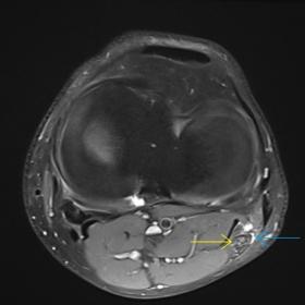 MR imaging of the left knee. Eight consecutive axial proton density-weighted images, with fat suppression, show a large hyperintense cystic lesion, with tubular, beaded configuration, within the epineurium of peroneal nerve (yellow arrows), with no fat plane between the cyst and the nerve, displacing the nerve fascicles, oriented longitudinally along the course of the nerve, compatible with an intraneural ganglion cyst (blue arrows). This intraneural ganglion cyst originates from the proximal tibiofibular j