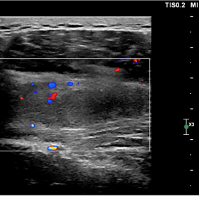 Ultrasound: Ill-defined heterogeneous intramuscular mass within infraspinatus muscle belly with minimal internal and peripheral vascularity.