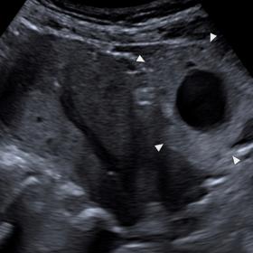 Sagittal ultrasound image reveals a complex pelvic mass (arrowheads) in front of the uterus, measuring 8.5 cm in the longest axis and with an estimated volume of 177 cm3. Applying gentle pressure with the transducer triggered severe pelvic pain.