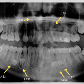 An up-to-date diagnostic OPG in March 2021 (post-pandemic) showed the presence of two additional ST. The first is visible in the lower left quadrant between the 35 and the 36 (LL$2), and the second is visible in the upper left maxillary segment between 23 and 25 (UL$1).