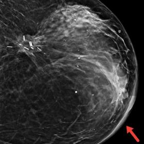 CC mammography of the left breast showing the thickened skin (red arrow). The postoperative scar is also visual in the lateral quadrant