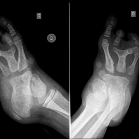 X-ray of the feet in an oblique position with bilateral complex bone malformations, characterized by syndactyly, Y-shaped fus
