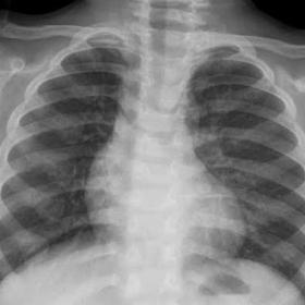 Chest X-ray posteroanterior view. Expansion of anterior ends of ribs is clearly evident and consistent with rachitic rosary.