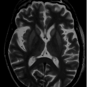 T2-WI showing bilateral and symmetrical hyperintensities of lentiform and caudate nuclei, with no involvement of the cortex o