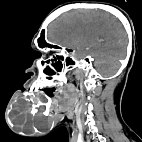 Contrast-enhanced axial and sagittal images reveal large multiloculated enhancing solid cystic expansile lytic lesion involving symphysis menti, the body of the mandible on both sides and alveolar arch with an enhancing solid component predominantly in the mental region. Few cysts show fluid-fluid levels and enhancing papillary projections.