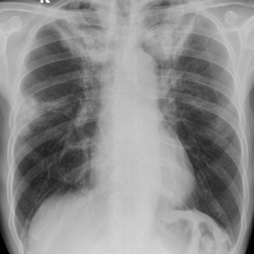 PA chest x-ray. Bilateral upper-lobe consolidations, as well as a peripheral consolidation in the middle third of the right l