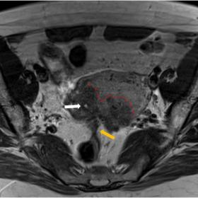 T2W image without fat suppression in the axial plane, demonstrating a bulky, irregular and hypointense thickening of the post