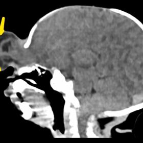 CT scan of the brain with sagittal reconstruction, brain window, showing herniation of the anterior part of anterior frontal 
