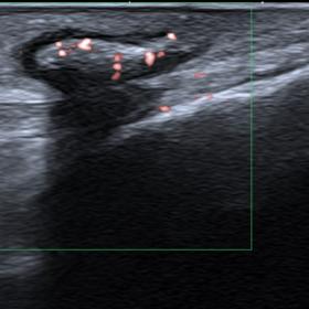 Doppler ultrasound shows punctiform signals in the larva, indicating its continued vitality. There is no hyperaemia of the su