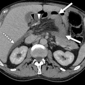 Axial contrast-enhanced CT image (1a) shows herniation of the small bowel (arrows) into lesser sac; the small bowel mesentery is located posterior to the portal vein (asterisk), hepatic artery (white arrowhead), and common bile duct (black arrowhead); free fluid in hepatorenal recess (dashed arrow). Coronal image (1b) shows small bowel mesentery herniating through the foramen of Winslow (dashed line). Sagittal image (1c) shows hypoenhancing herniated small bowel within the lesser sac (dashed line), between 