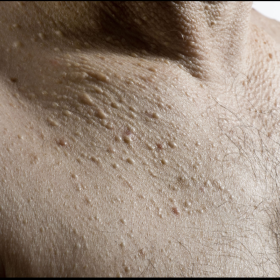 Skin changes, with fibrofolliculomas on chest and back.