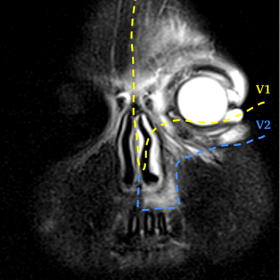 Coronal T2-weighted image DIXON (W) shows the perfect delimitation of the soft tissue inflammation on the trigeminal V1 (gre