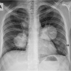 Posteroanterior chest X-ray displays sizable bilateral opacities, predominantly located in the perihilar region.