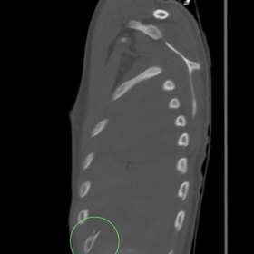 CT bone window (5a), VRT (5B) and zoomed image (5c) showing rib spur arising from the inner aspect of the left 6th rib.