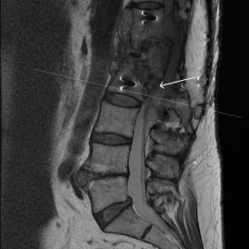 Sagittal Proton Density Fast Spin-Echo (PD FSE) MRI of the lumbosacral spine showing an extensive multicystic mass extending from Th12 to L2 vertebra with newly developed marked spinal stenosis at the L2 level (white arrow).