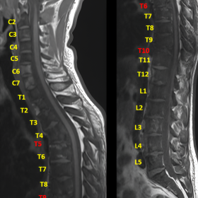 Sagittal T1-weighted images. The fractured vertebrae (highlighted in red) differ in level when counted from the uppermost cervical level (C2) downwards (A) or from the lumbar region (L5) upwards (B).
