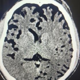 CT head showing pneumocephalus within the sulci, and ventricle with subcutaneous soft tissue swelling in the left frontal region.