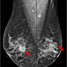 Mammography mediolateral (MLO) views showing bilateral partially obscured masses with no calcifications.