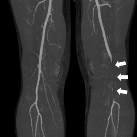 Coronal plane CT MIP during active plantar flexion showing absent opacification of the P2 and P3 segments of the popliteal artery (white arrows). There is re-injection of contrast at the distal P3 segment just above the level of the bifurcation.