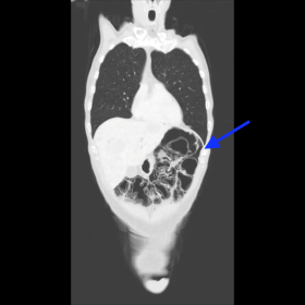 Coronal venous phase CT with lung window setting demonstrates pneumatosis coli with air under the submucosal layer of the colon wall.