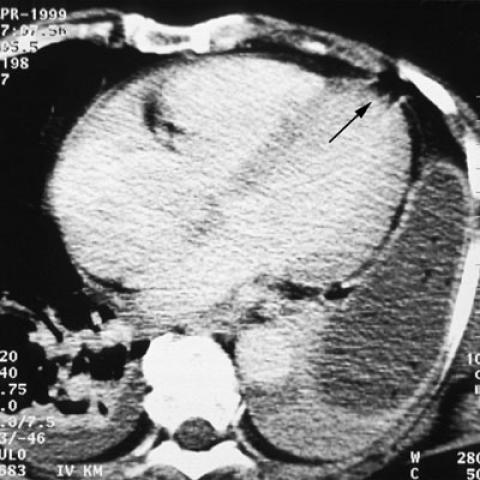 Concomitant pericardial and left diaphragmatic rupture, with ...
