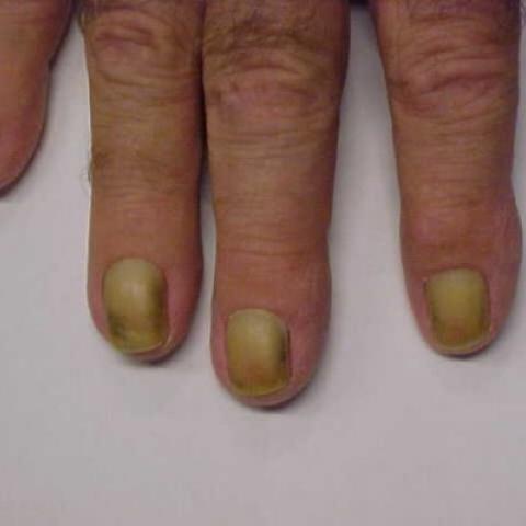 Onychomycosis Fungus Infection On Nails Stock Photo - Download Image Now -  Body Care, Close-up, Condition - iStock