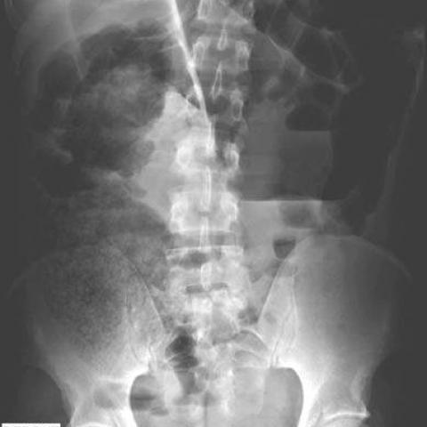 Sigmoid Volvulus In A Young Adult Eurorad