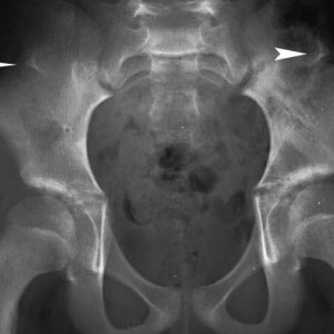 Nail patella syndrome | Radiology Case | Radiopaedia.org