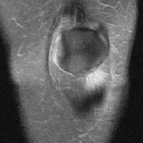 Patellar tendon-lateral femoral condyle friction syndrome, Radiology  Reference Article