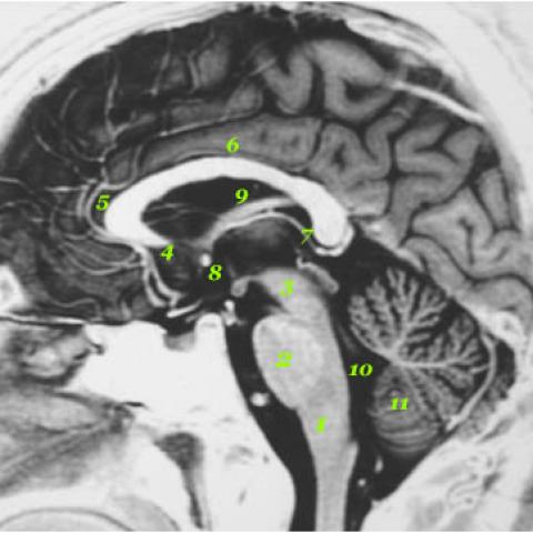cerebellum anatomy mri