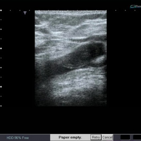 popliteal vein ultrasound